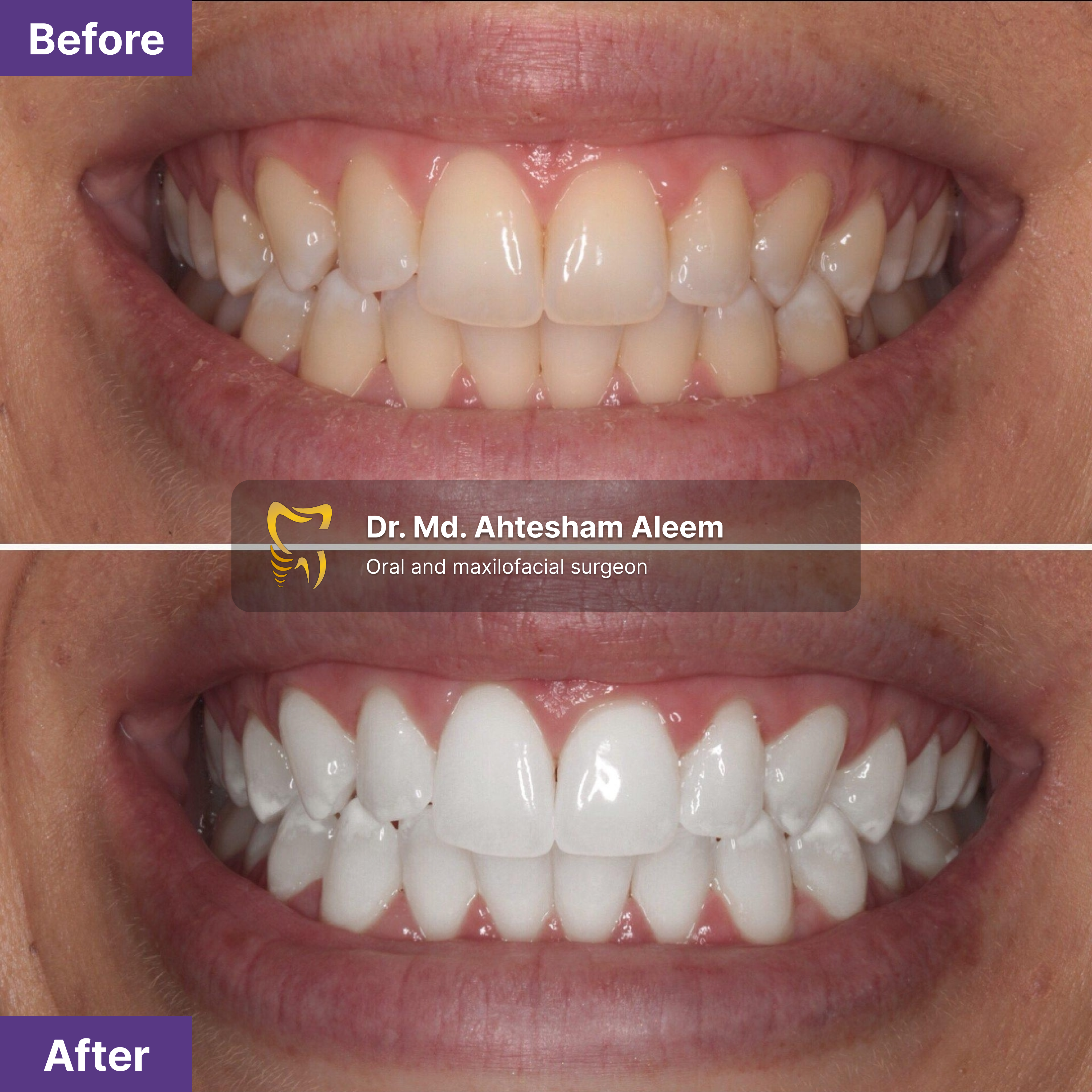 Teeth Whitening Image 1